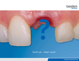 Tooth out – what’s next